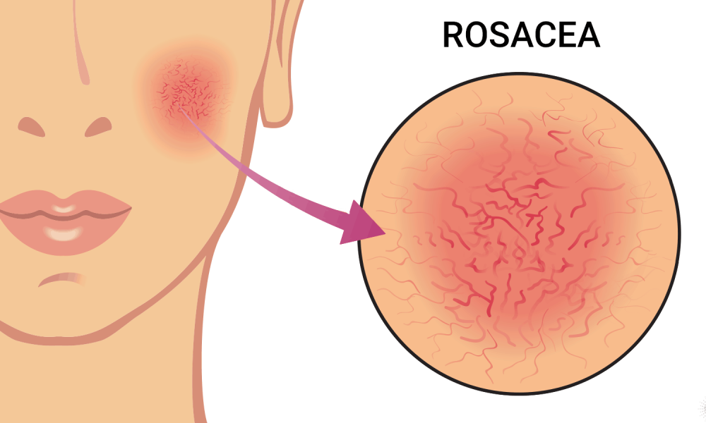 Aprile il mese internazionale della rosacea, la malattia cronica della pelle pic