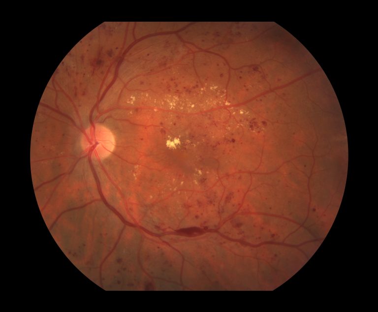 retinopatia diabetica