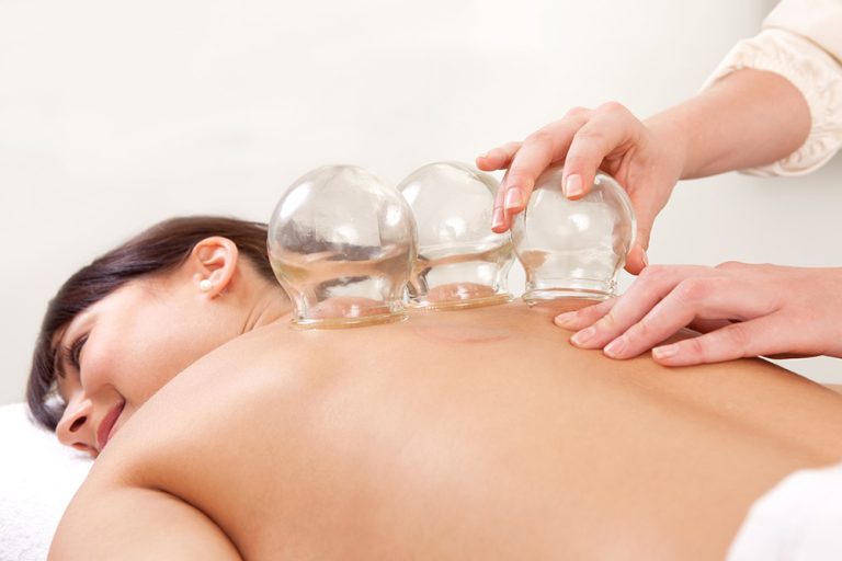 Cupping therapy