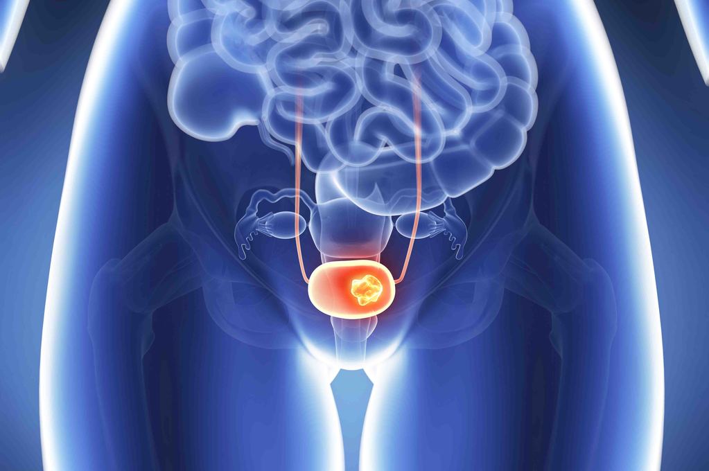 cancro alla vescica