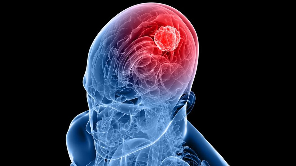 glioblastoma