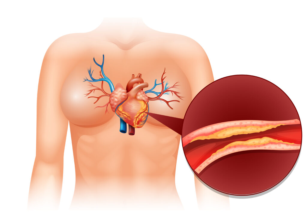 colesterolo, arterie, malattie cardiovascolari, regola delle 3L