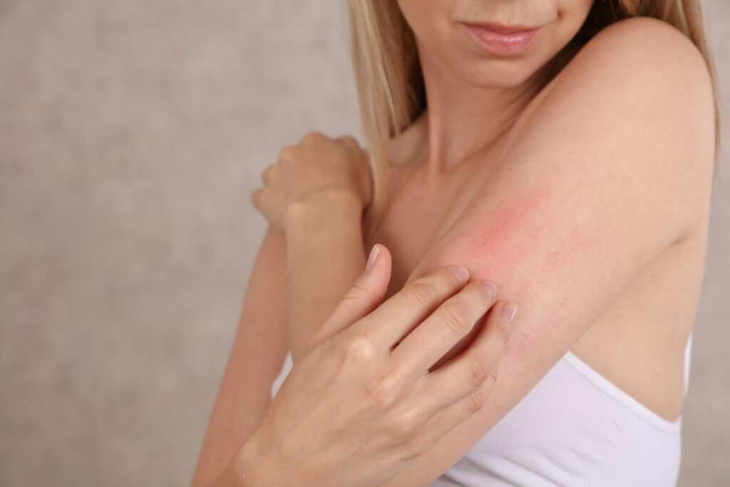 ORTICARIA CRONICA SPONTANEA, COSTI INDIRETTI . COMUNICATO STAMPA 