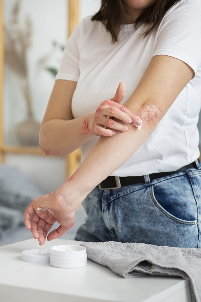 psoriasi, malattia infiammatoria cronica, terapie, patologia, ricerca, remissione, controllo