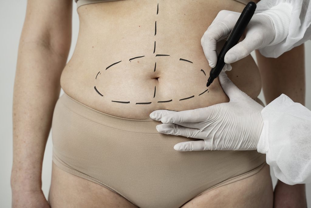 chirurgia estetica, farmaco, bisturi, CBL-514, adipociti, liposuzione, grasso viscerale, grasso localizzato